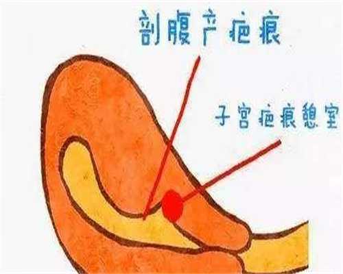 代生代怀费用：子宫内膜异位症做试管有影响吗？子宫内膜异位症做试管能成功吗？