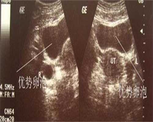 正常卵泡与异常卵泡发育的超声检查